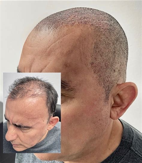 colmek+smp|Miami Scalp Micropigmentation 